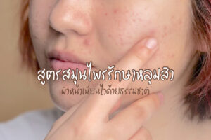 สูตรสมุนไพรรักษาหลุมสิว ผิวหน้าเนียนไวด้วยธรรมชาติ!