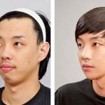 ก่อนจัดฟัน หลังดัดฟัน