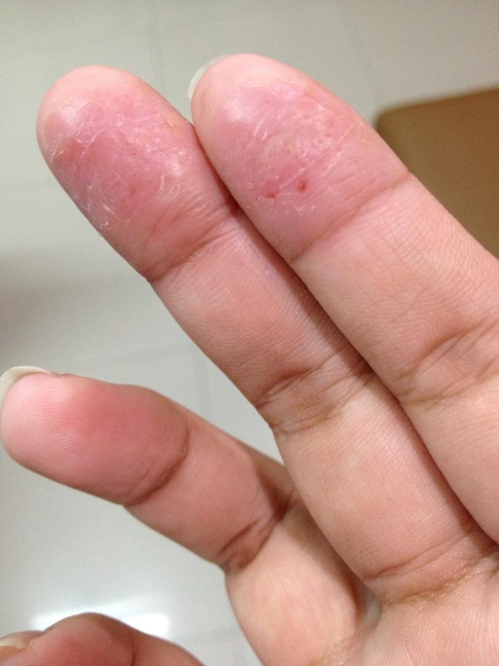 วิธีแก้มือลอก