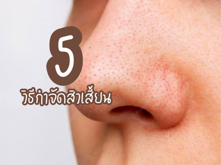 5วิธีกำจัดสิวเสี้ยน