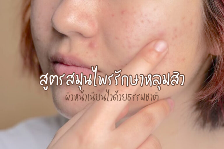 รักษาหลุมสิว