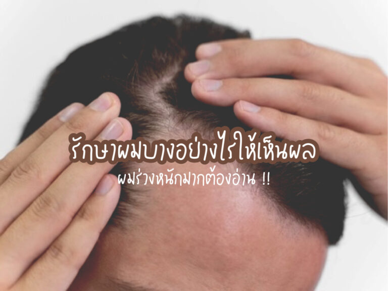 รักษาผมบาง